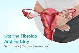 uterine fibroids and fertility