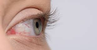 blood vessels burst in the eye