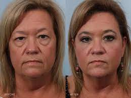 how much does eyelid surgery cost