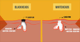 home remes for removal of whiteheads