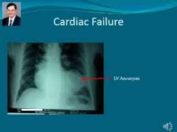 Congestive Heart Failure Case Study Scribd