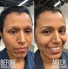 video eyebrow microblading for cancer