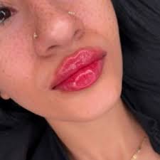 lip fillers in forest hills queens nyc