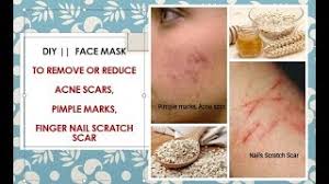 acne scars nails scratch scar diy