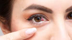 what a broken blood vessel in eye means