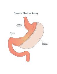 sleeve gastrectomy ut health tyler
