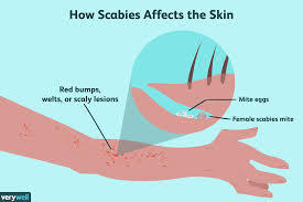 how to prevent scabies