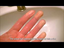 raynaud syndrome sudden white finger