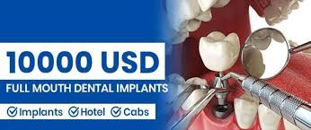 full mouth dental implants cost 10