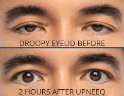 upneeq for droopy eyelids hayes