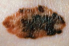melanoma skin cancer symptoms nhs