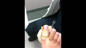 ingrown toenail removal permanent