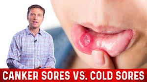 canker sores vs cold sores dr berg
