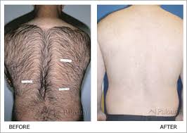Laser hair removal can help minimise the effects of folliculitis on hair follicles. Palomar Medical Laser Permanent Hair Reduction Johannesburg