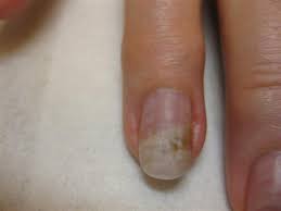 does nail polish cause nail fungus