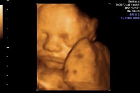 Etwa ab der 30.ssw sind die merkmale und gesichtszüge des babys im 3d ultraschallbild gut zu erkennen. 3d 4d Ultraschall Praxisklinik Wuppertal
