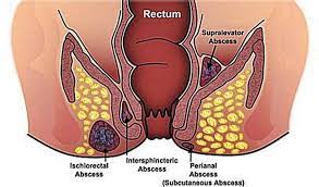 ano rectal abscess eopathic treatment