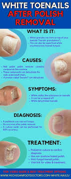 white chalky toenails from nail polish