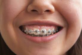 can my braces cause swollen gums
