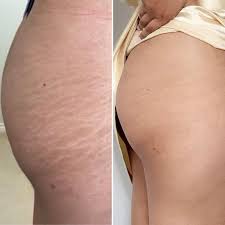 stretch mark tattoo camouflage in