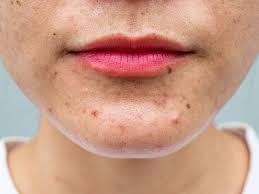 what acne spots on your face mean