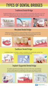 dental bridges in baltimore md