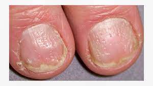 nail psoriasis vs fungus learn the signs