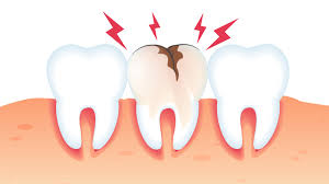 broken tooth repair your options