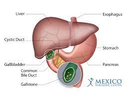 gallstones after weight loss surgery