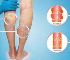 varicose vein treatment and procedures
