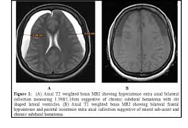 Both epidural and subdural hematomas involve bleeding outside of the brain and either outside or inside of the dura mater. Ajns African Journal Of Neurological Sciences Bilateral Subdural Hematoma A Rare Complication Of Common Procedure In 30 Year Old Female Patient A Case Report And Literature Review
