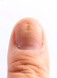 5 common nail conditions