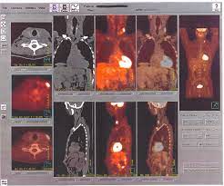 Fichier:PET scan image.jpg — Wikipédia