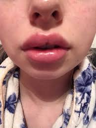 uneven swelling after lip filler 1 day