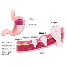 partial gastrectomy stomach cancer