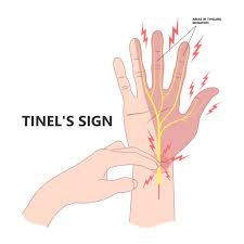 carpal tunnel syndrome non surgical