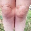 A direct blow to the front of knee can also cause prepatellar bursitis. Https Encrypted Tbn0 Gstatic Com Images Q Tbn And9gcqda3jnznp6hlsjffkbaygkwz8mu5hqfv5x0 Mla13bbfgutsee Usqp Cau