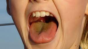 yellow tongue causes treatment