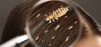 head lice using homeopathic remes