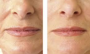 remove deep wrinkles around the mouth