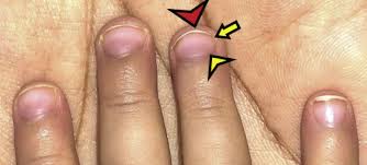 nail changes in cirrhosis and reversal