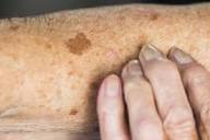 What's the difference between age spots and sun spots? - Harvard ...