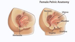 prolapse surgery rectocele repair