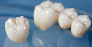 Image result for dental bridge zirconia