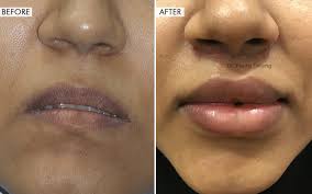 results lip augmentation before and after