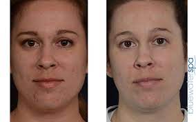 north ina rosacea and vein treatment