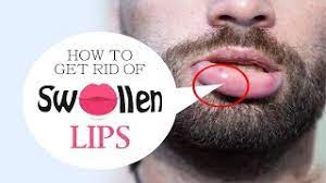 swollen lips causes symptoms