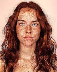 why do freckles fade as redheads age