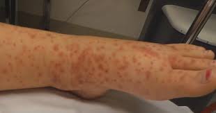 Purpura happen when blood leaks from blood vessels and collects under the skin or mucus membrane. Purpura And Petechiae In Children