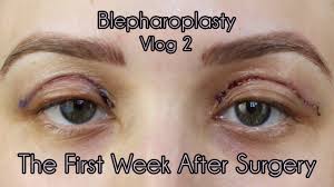 eyelid surgery recovery tips what to